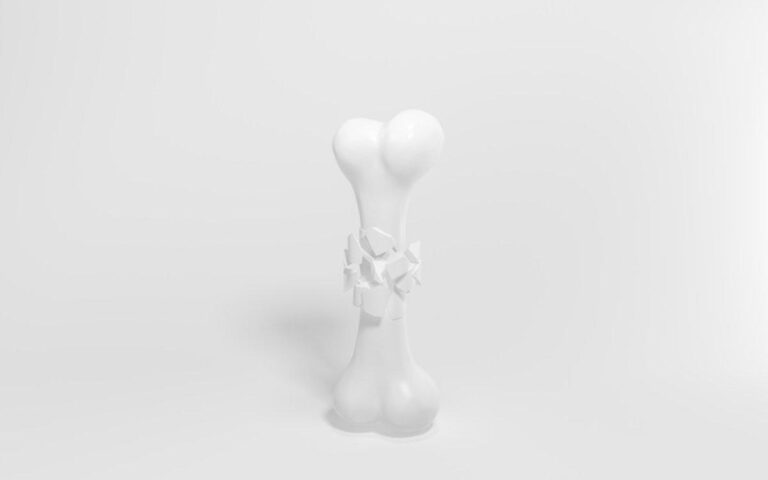 impresión 3D de hueso en el quirófano