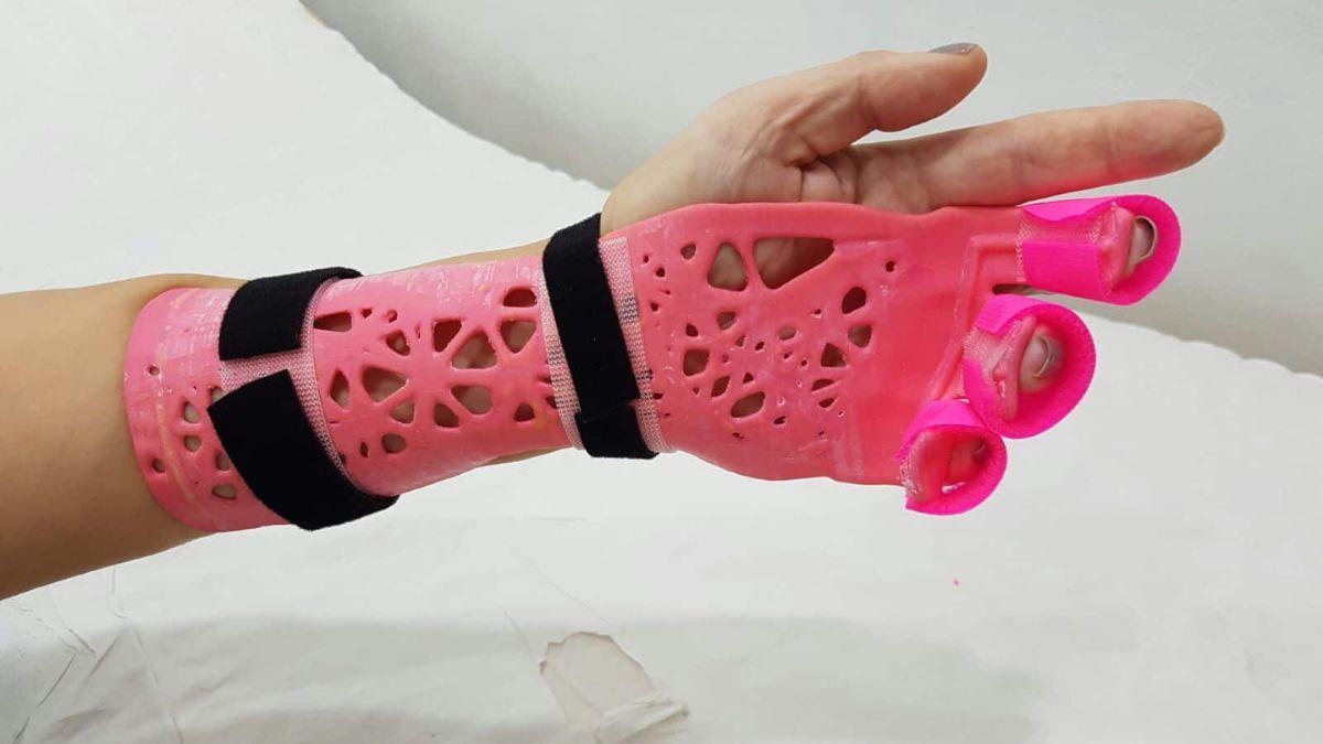 Impresión 3D ortopedia Proceso de impresión de férulas ortopédicas