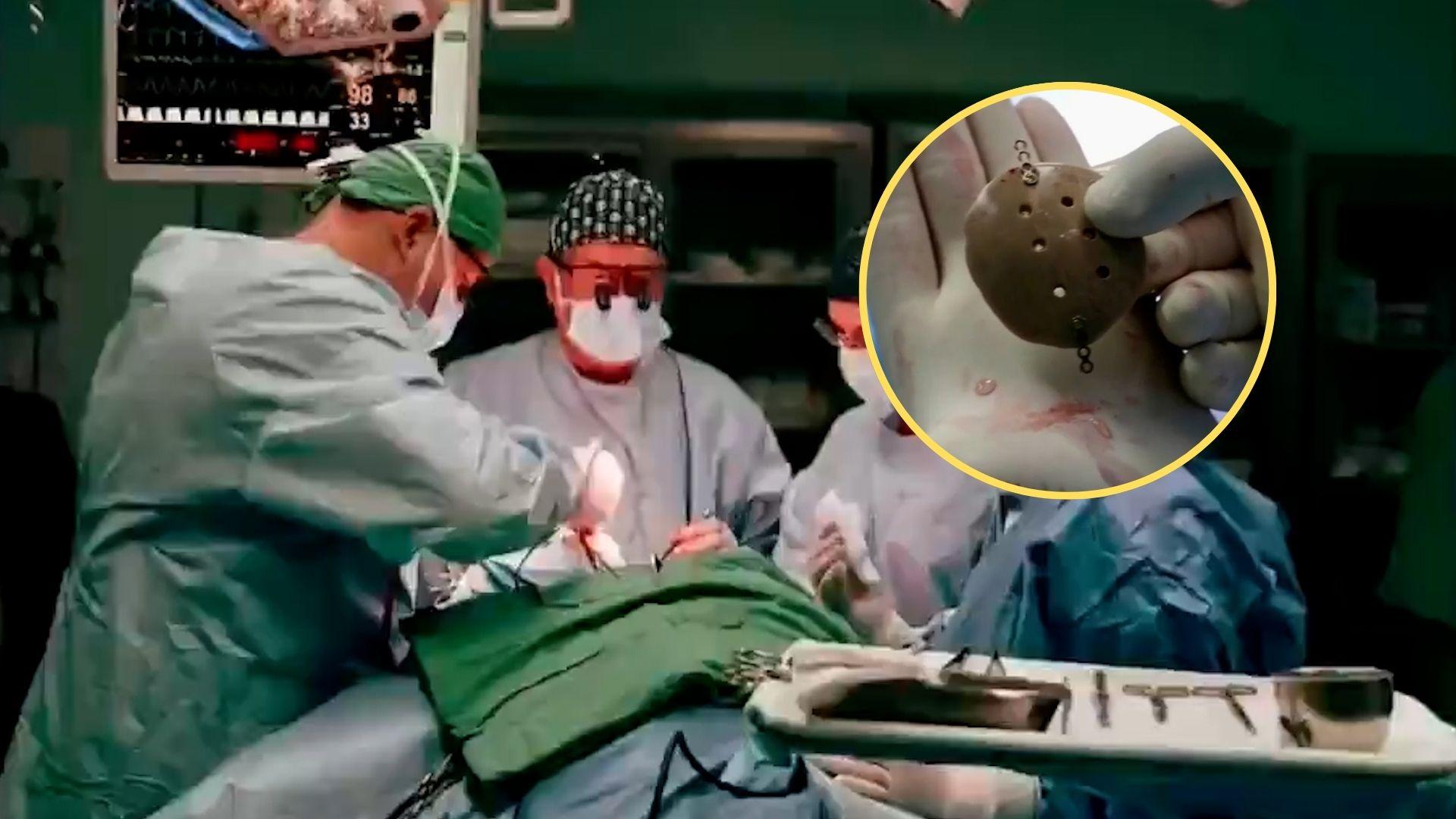 Equipo médico con prótesis craneal impresa en 3D